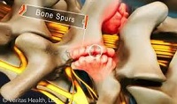 Osteophyte video, spur formation, canal stenosis video